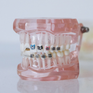 Brackets, ortodoncia21