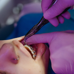 Brackets, ortodoncia