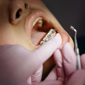 Brackets, ortodoncia